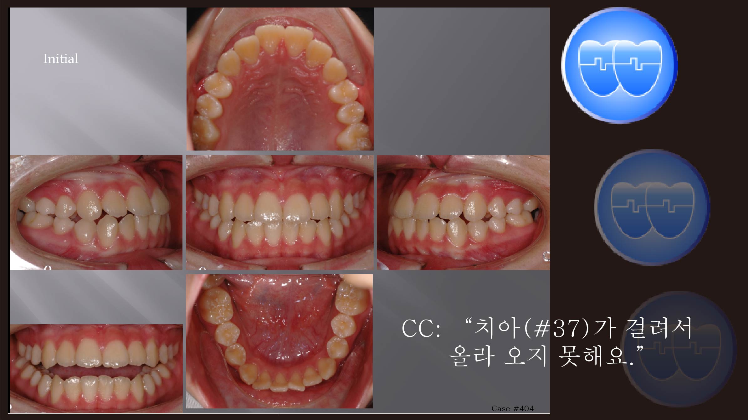 교정 Case 404.  비발치, Class III, #37 Blockout and Upright, Sem #14