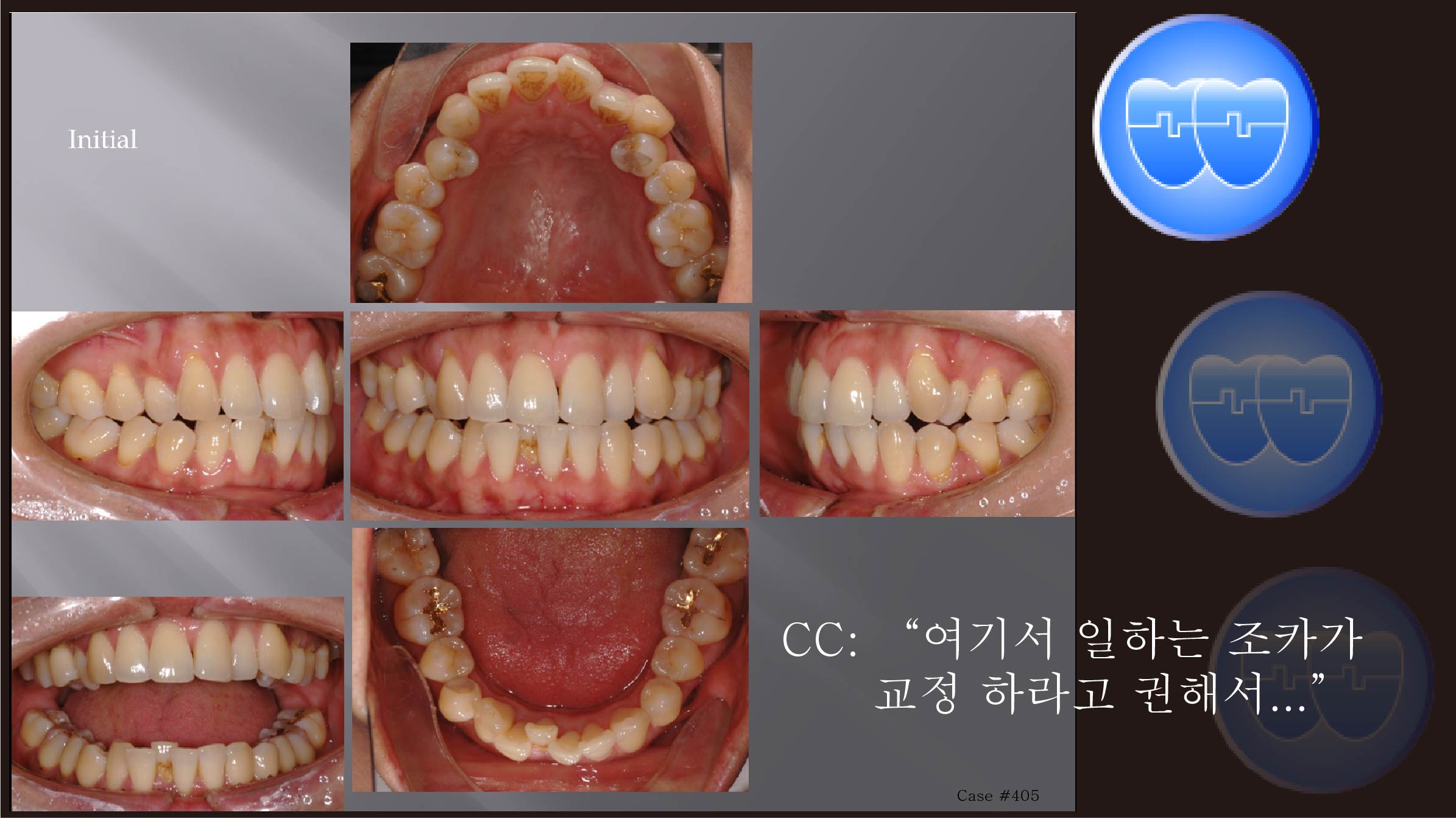 교정 Case 405.  U5L1 Extraction, Skeletal Class II, Crowding, Sem #13