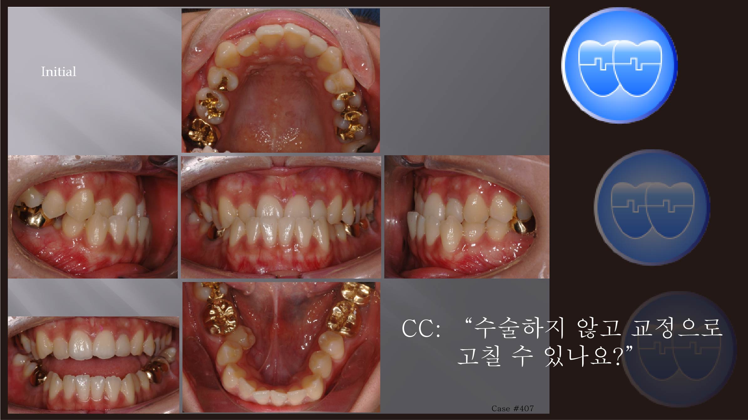 교정 Case 407.  L5 발치 , Class III, Tilted Occlusal Table, Sem #7.7