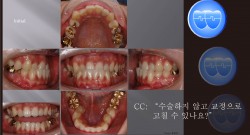 교정 Case 407.  L5 발치 , Class III, Tilted Occlusal Table, Sem #7.7