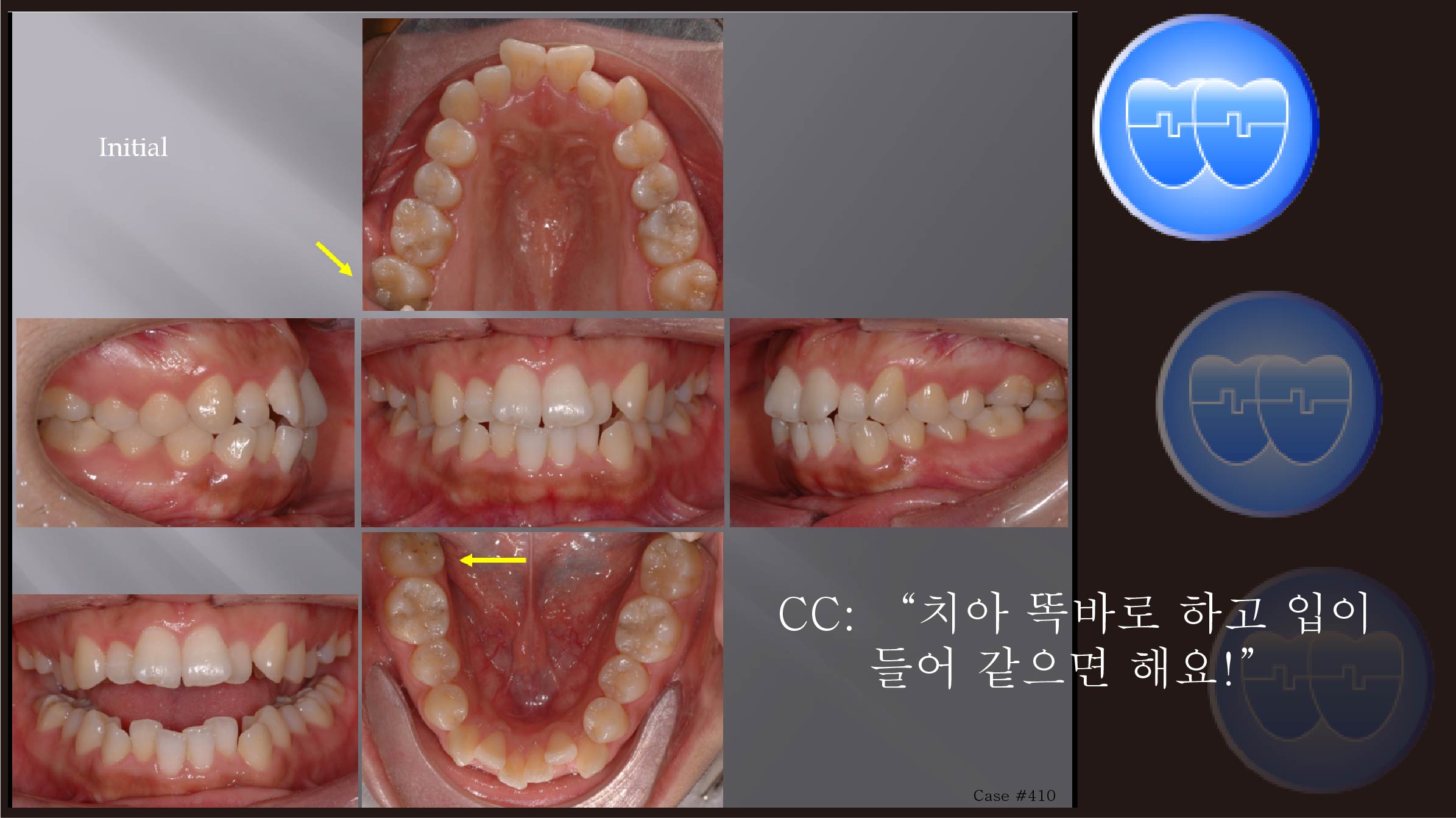 교정 Case 410.  U5L5 발치, Class III, Protrusion, Scissor-bite, Sem #12.4