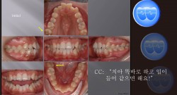 교정 Case 410.  U5L5 발치, Class III, Protrusion, Scissor-bite, Sem #12.4