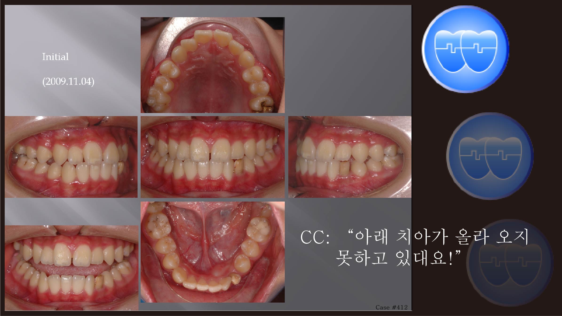 교정 Case 412.  Impacted Lower #33, Limited Time, Sem #14