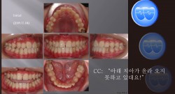 교정 Case 412.  Impacted Lower #33, Limited Time, Sem #14