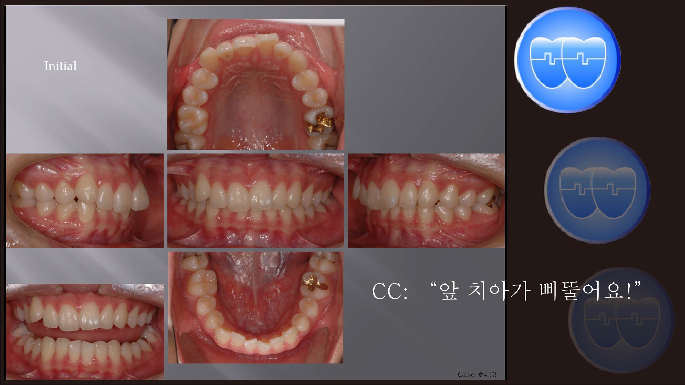 교정 Case 413.  U5 발치 Only, U5 발치의 매력, Dental Deepbite, Sem #6