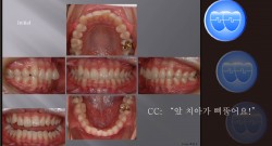 교정 Case 413.  U5 발치 Only, U5 발치의 매력, Dental Deepbite, Sem #6