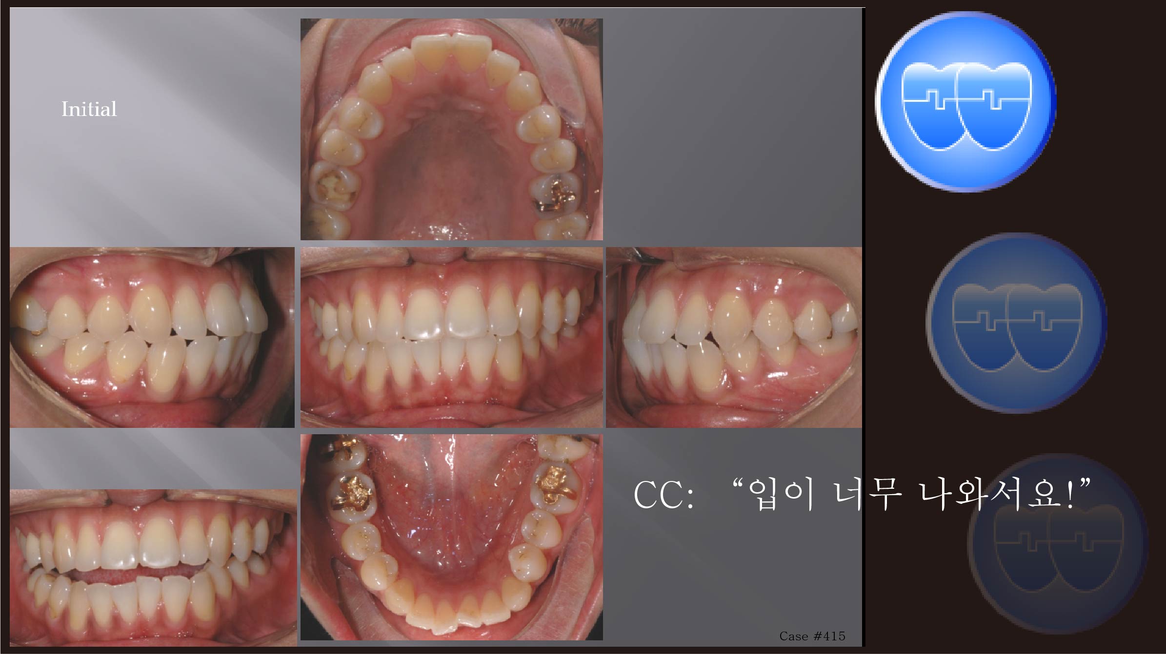 교정 Case 415.  U4L5 발치, Functional Shift, Midline, Lower Miniscrews, Sem #10