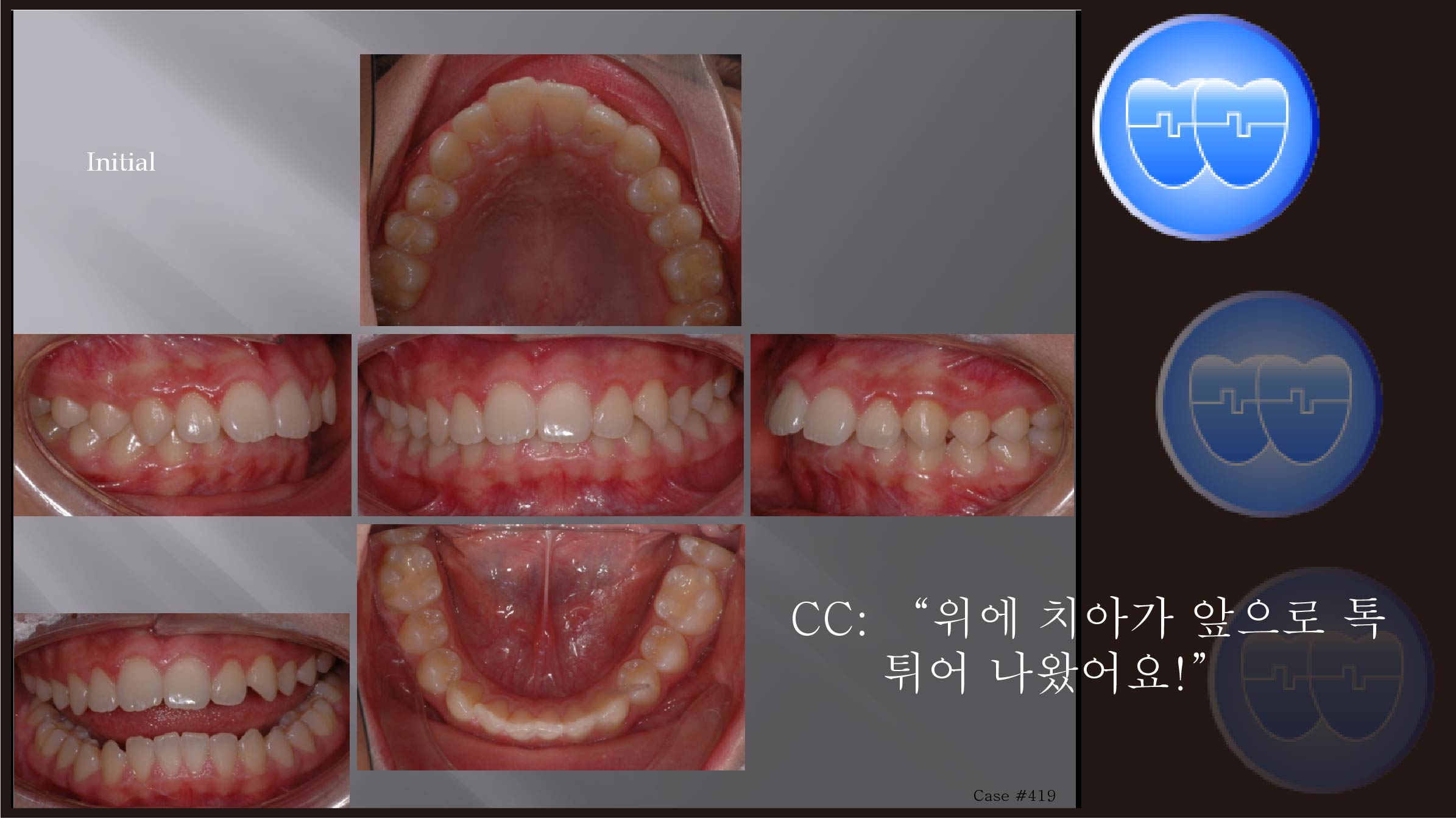 교정 Case 419.  U4 발치, Retraction, Miniscrews, Sem #12.5