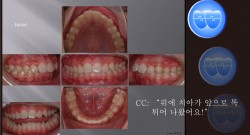 교정 Case 419.  U4 발치, Retraction, Miniscrews, Sem #12.5