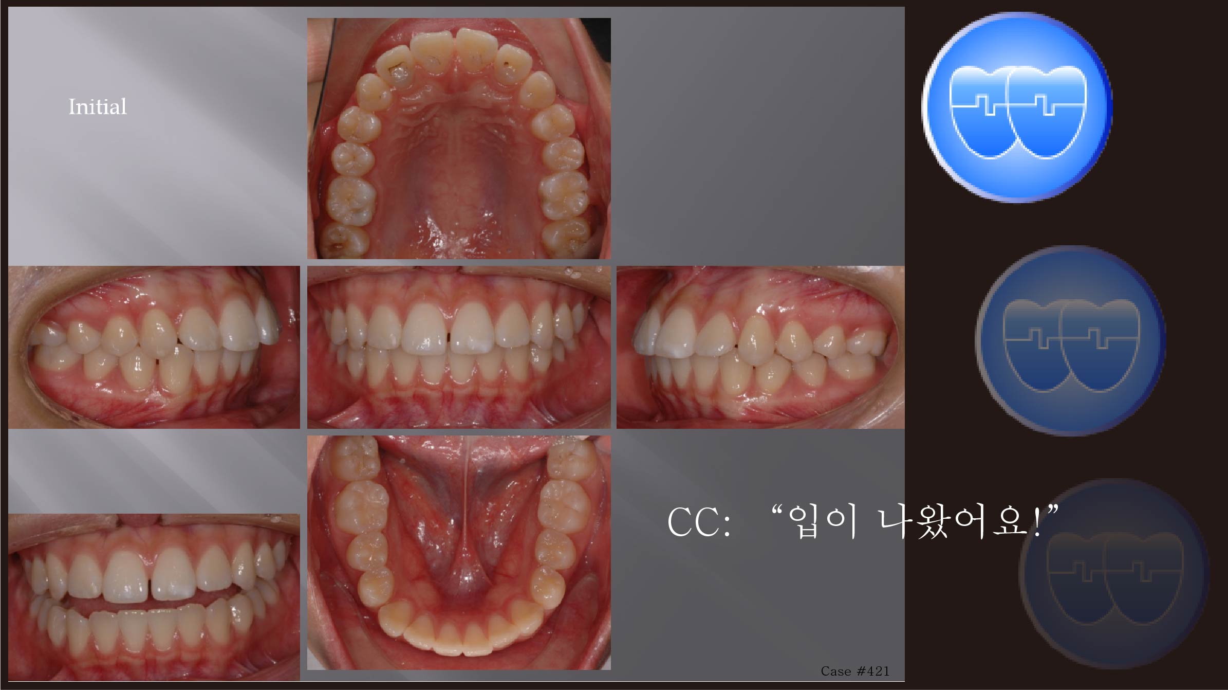 교정 Case 421.  U4L5 발치, Skeletal Class I, 여자, Gummy Smile 가능성, Sem #10