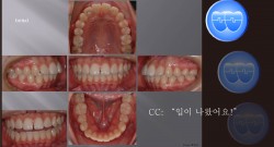 교정 Case 421.  U4L5 발치, Skeletal Class I, 여자, Gummy Smile 가능성, Sem #10