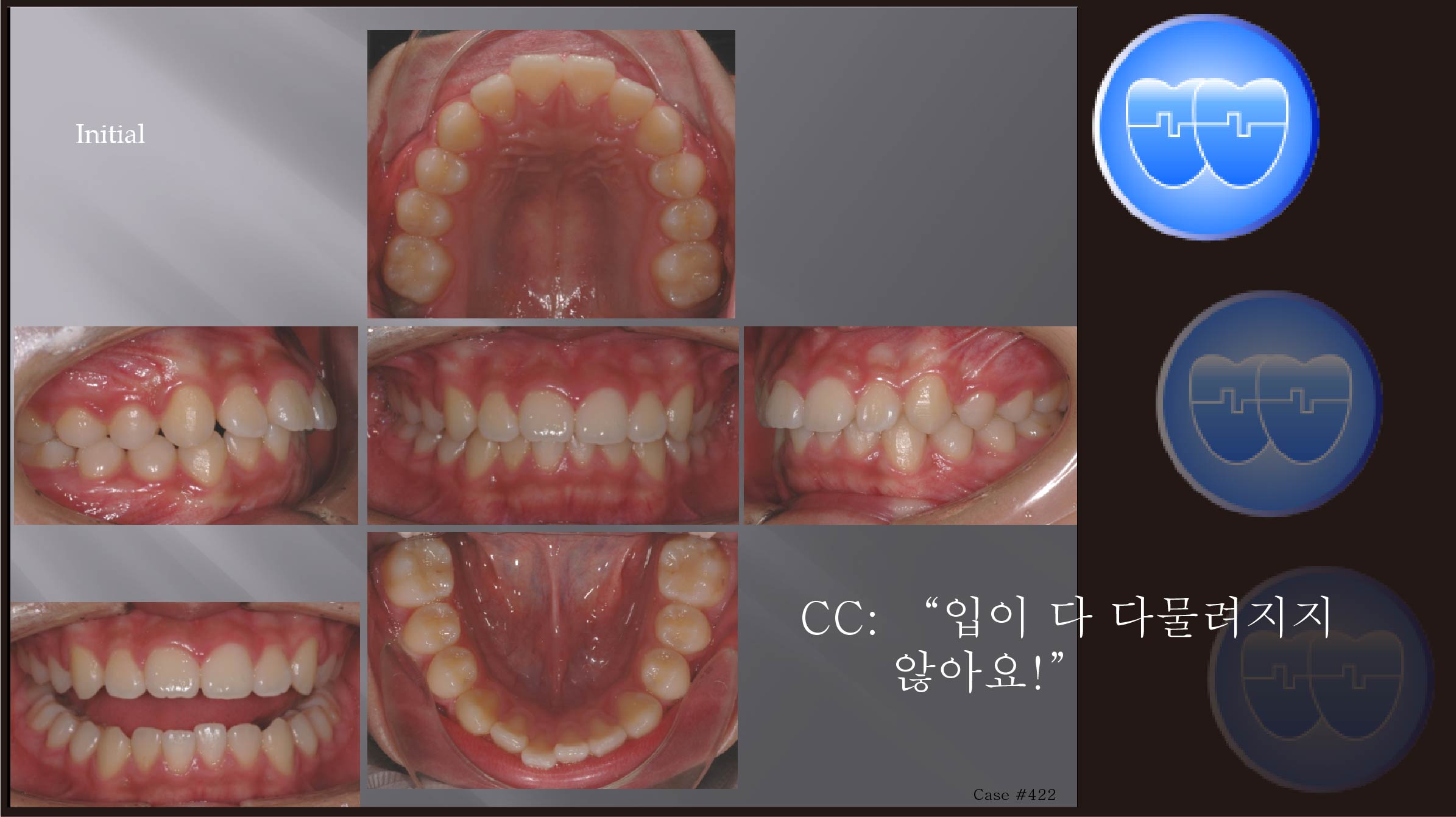 교정 Case 422.  U4L4발치, Gummy Smile, Sem #7.5