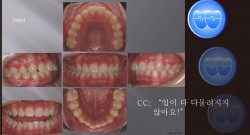 교정 Case 422.  U4L4발치, Gummy Smile, Sem #7.5