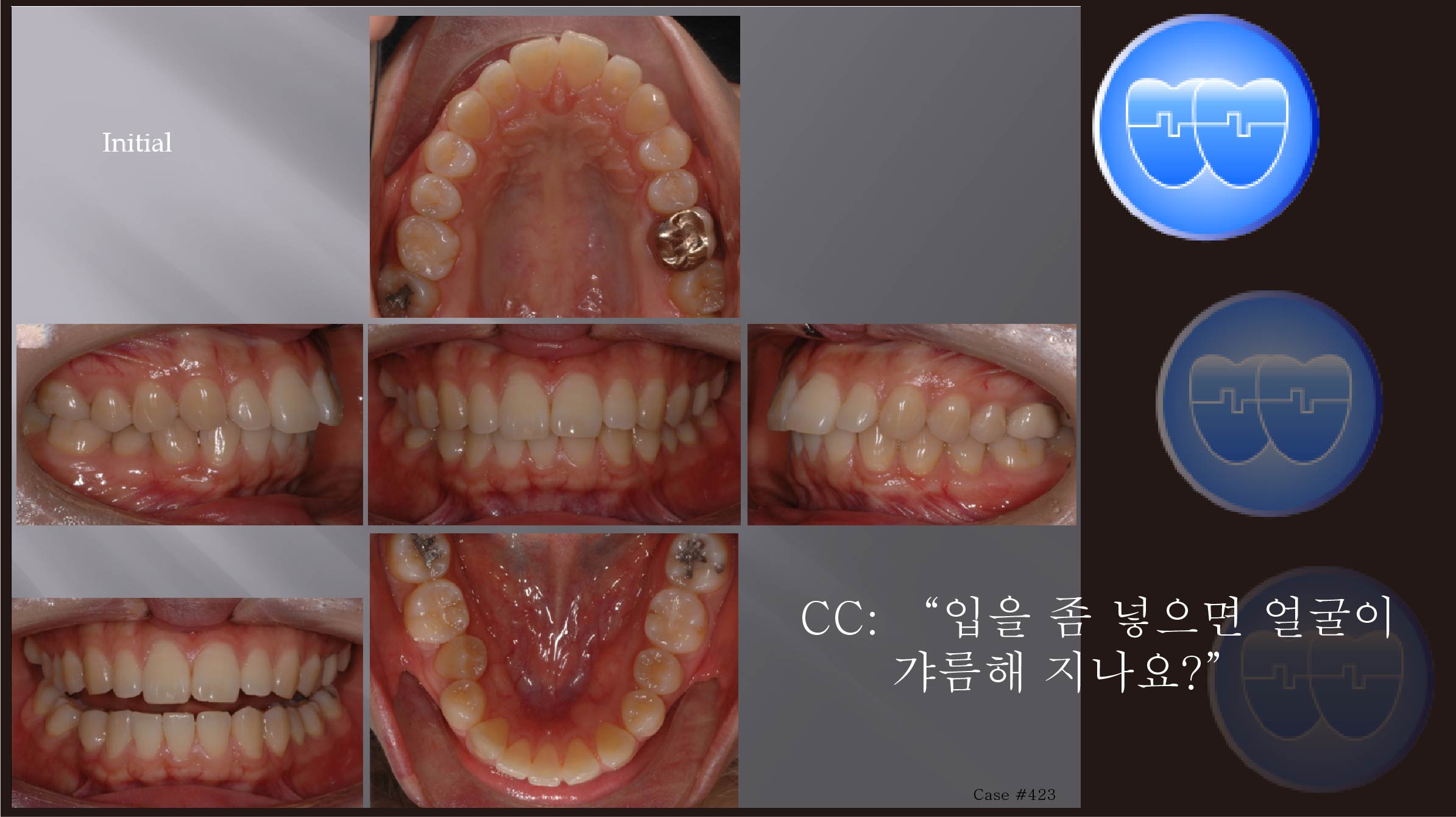 교정 Case 423.  비대칭 발치, U4U6 발치, Lower Stripping, Three Lower Incisors, Sem #13.2