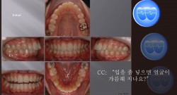 교정 Case 423.  비대칭 발치, U4U6 발치, Lower Stripping, Three Lower Incisors, Sem #13.2