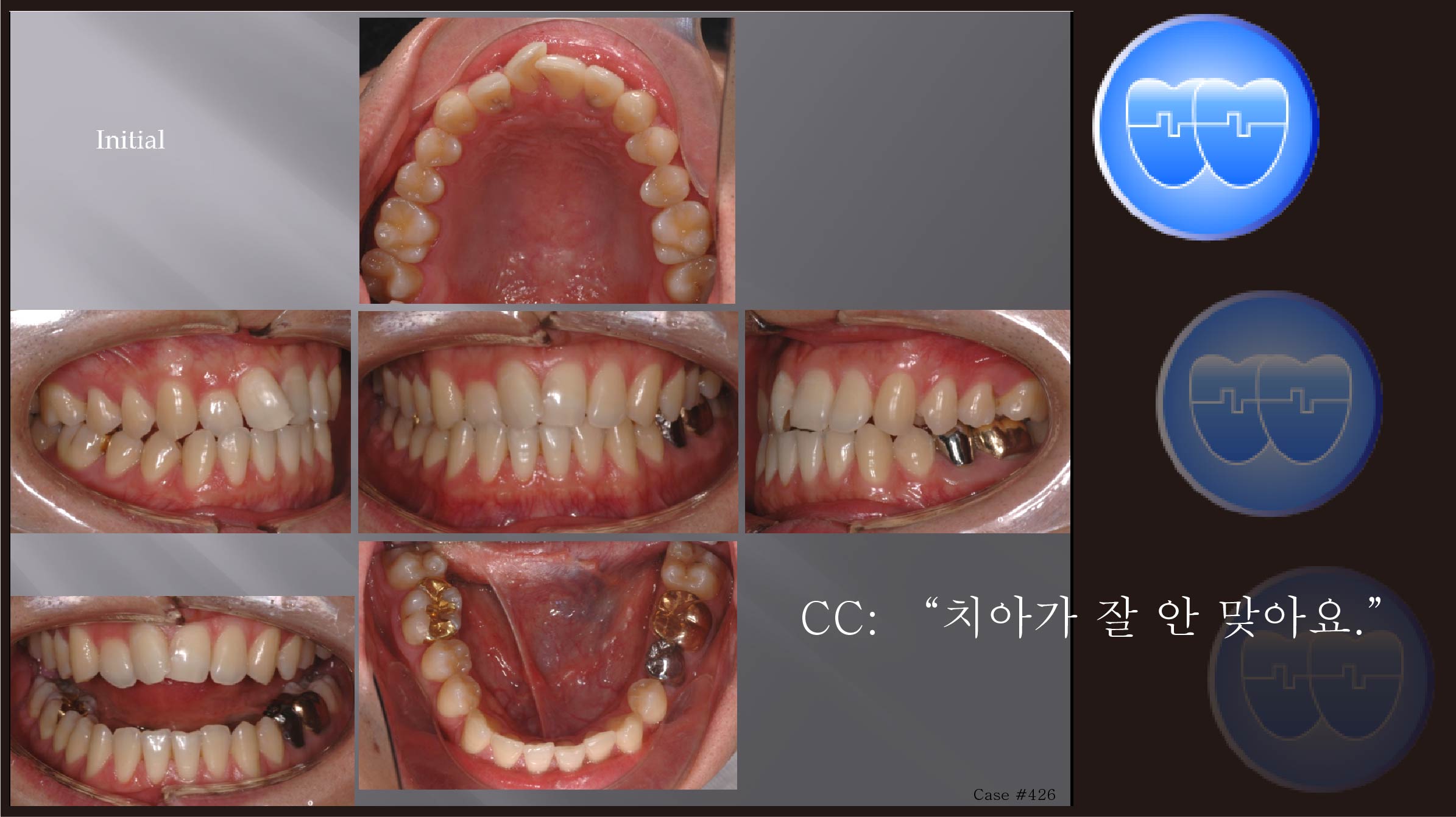 교정 Case 426.  비발치, Class III, 성인 교정, Sem #7