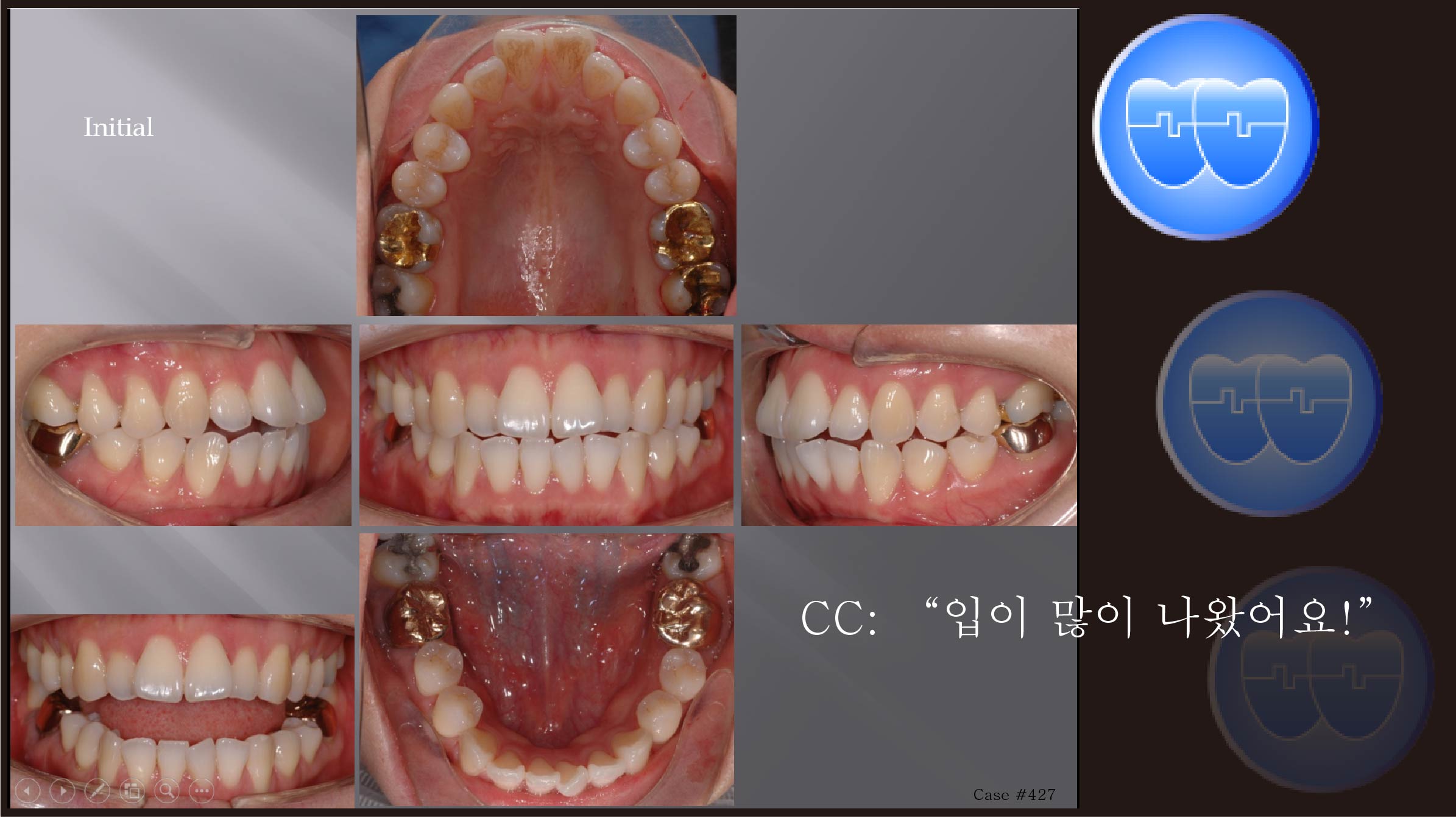 교정 Case 427.  비대칭 발치, Class I, Protrusion, Sem #13.2