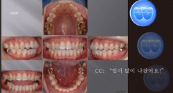 교정 Case 427.  비대칭 발치, Class I, Protrusion, Sem #13.2