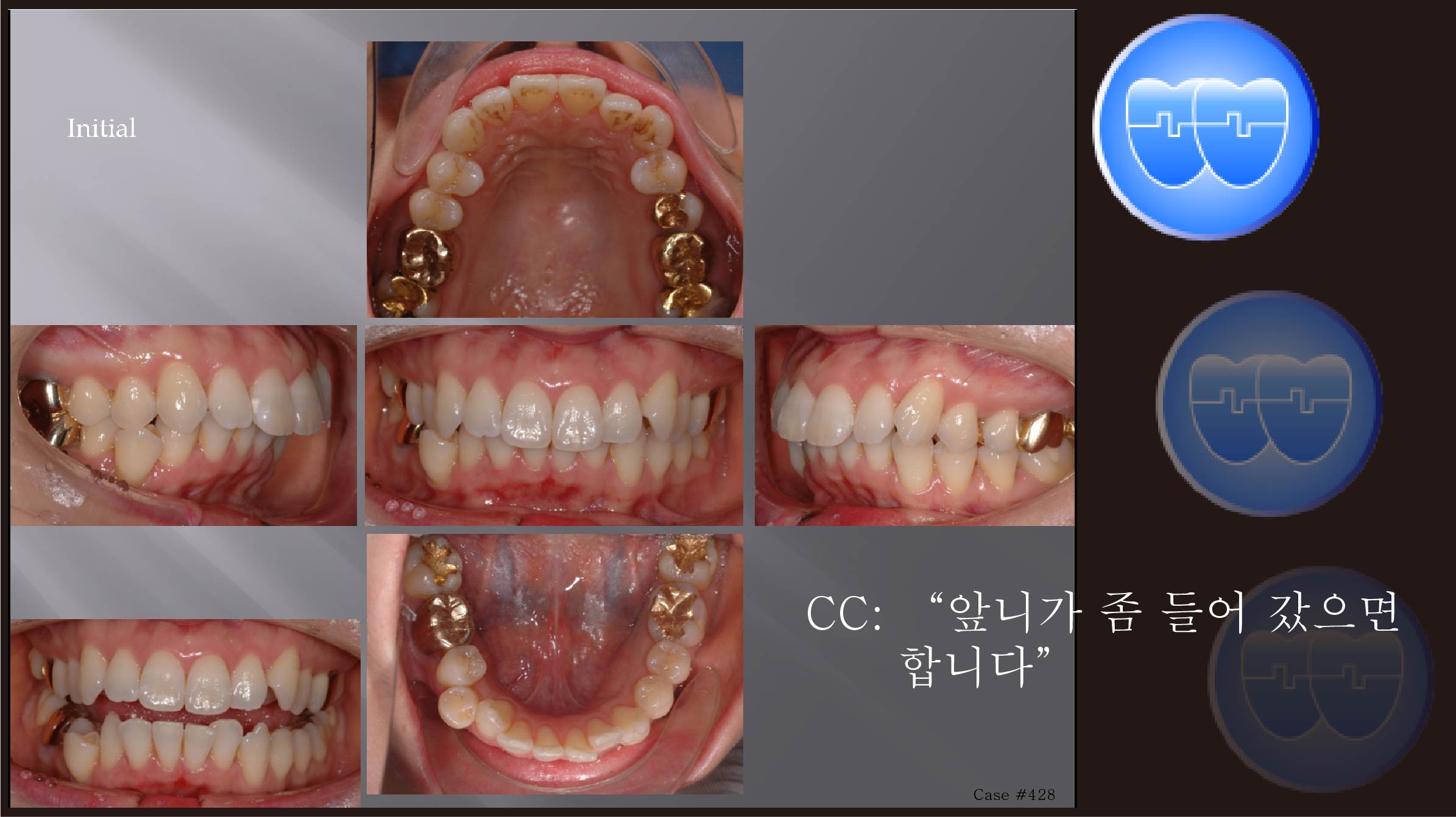 교정 Case 428.  U5 발치, Upper Palatal Corticotomy, Sem #12.6