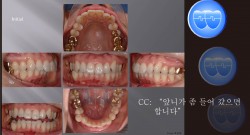 교정 Case 428.  U5 발치, Upper Palatal Corticotomy, Sem #12.6