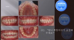 교정 Case 429.  U4L4 발치, Skeletal Class III, Sem #4