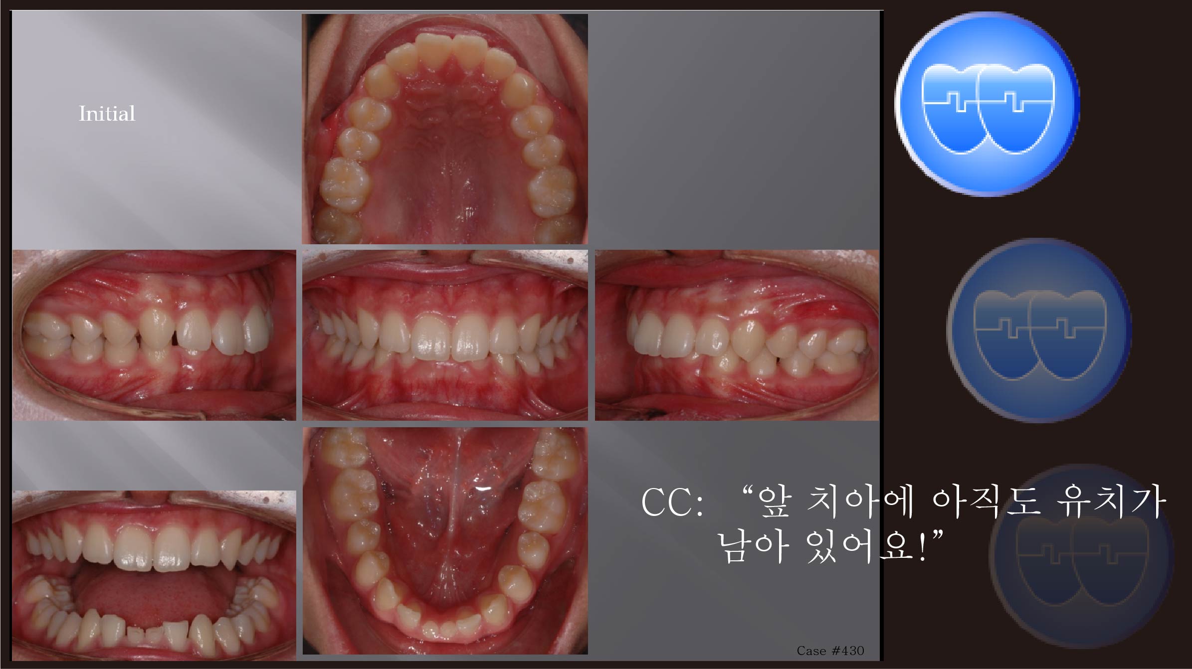 교정 Case 430.  Congenital Missing of Two Lower Incisors, Sem #13