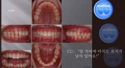 교정 Case 430.  Congenital Missing of Two Lower Incisors, Sem #13