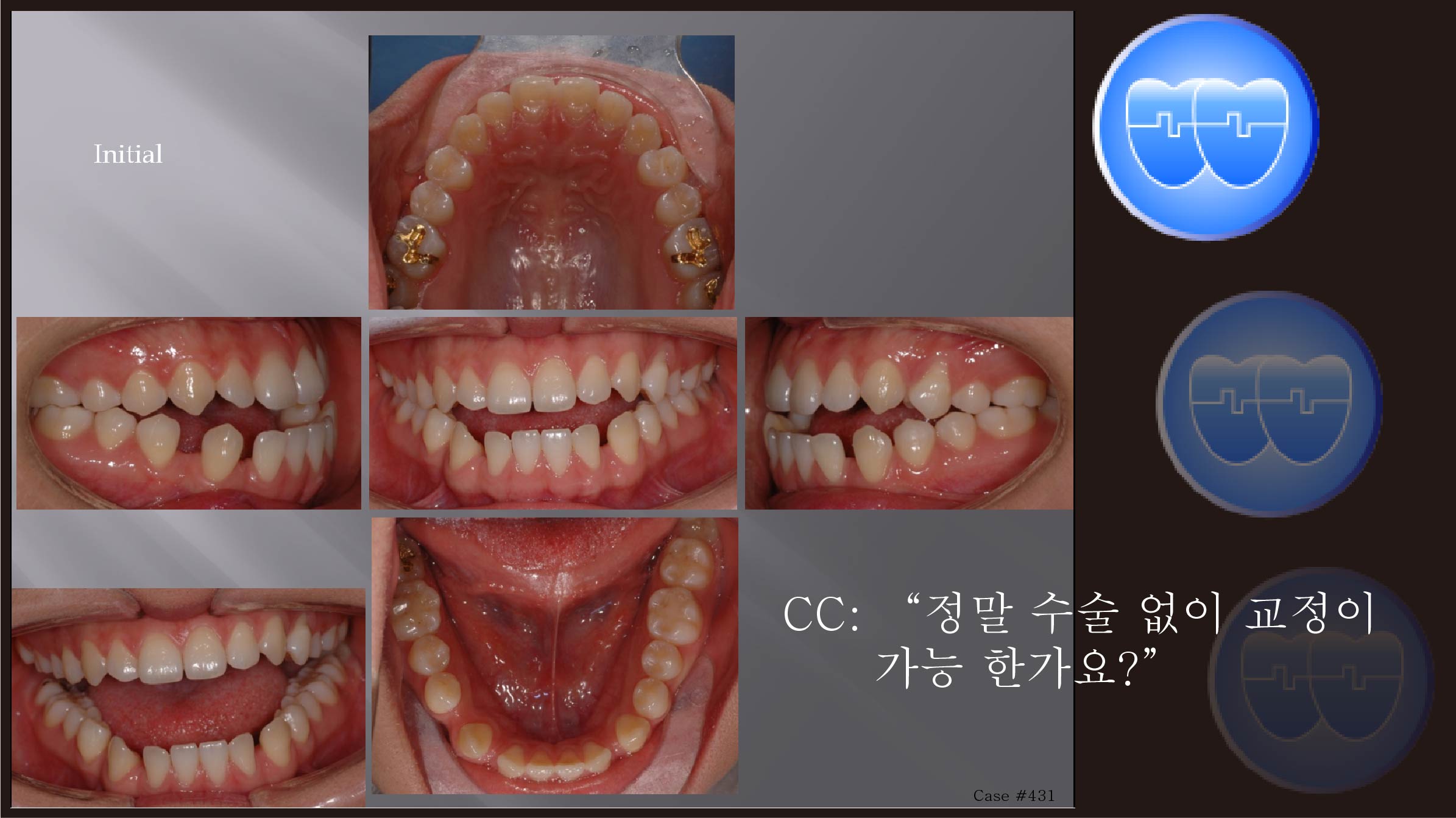 교정 Case 431. Dental Openbite, 비발치, Intrusion of Upper Molar with Miniscrews, Lower Corticotomy, Sem #7