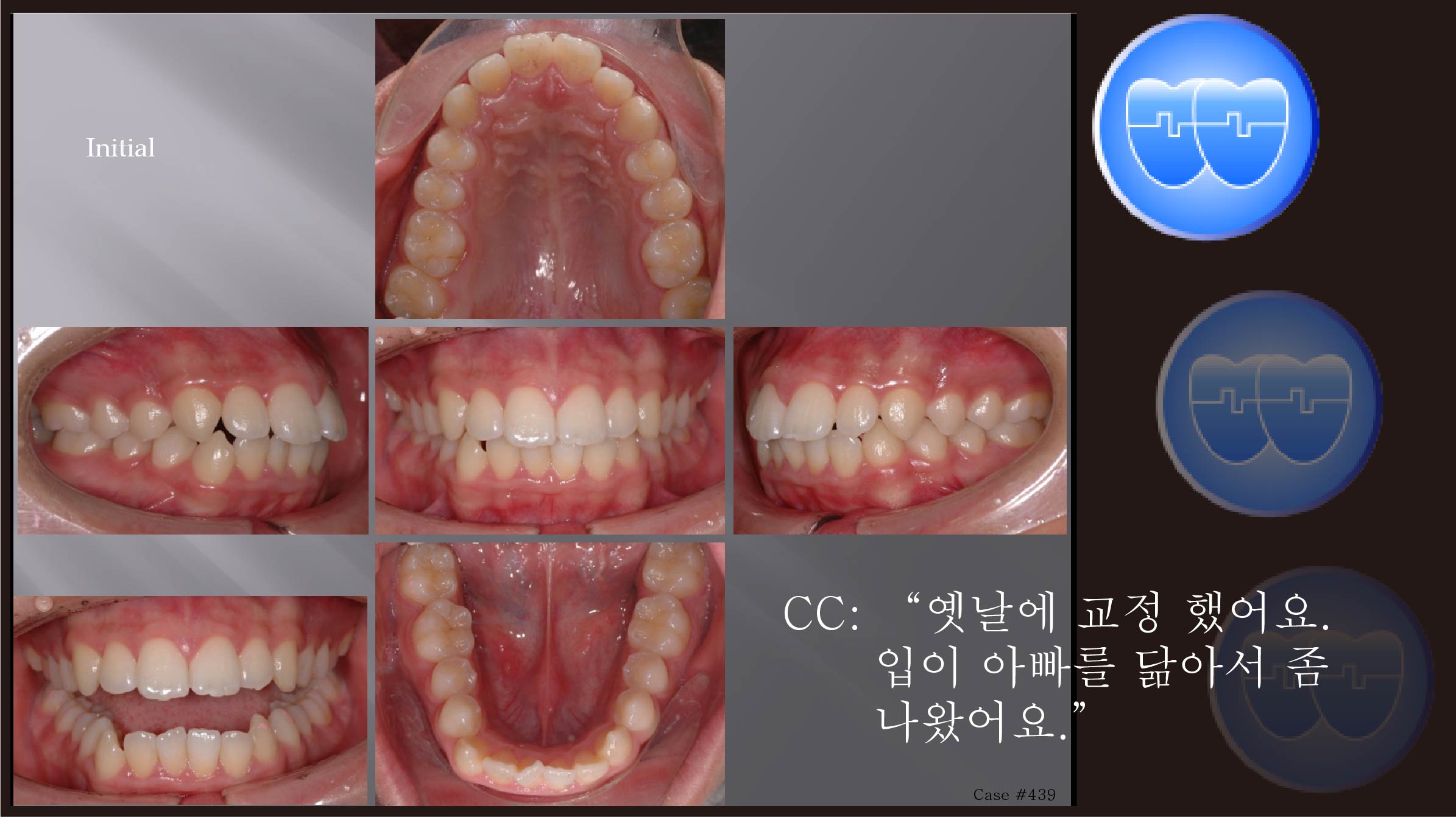 교정 Case 439.  재교정, U4L5 발치, Gummy Smile 가능성, Protrusion, Sem #7.5