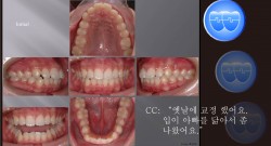 교정 Case 439.  재교정, U4L5 발치, Gummy Smile 가능성, Protrusion, Sem #7.5