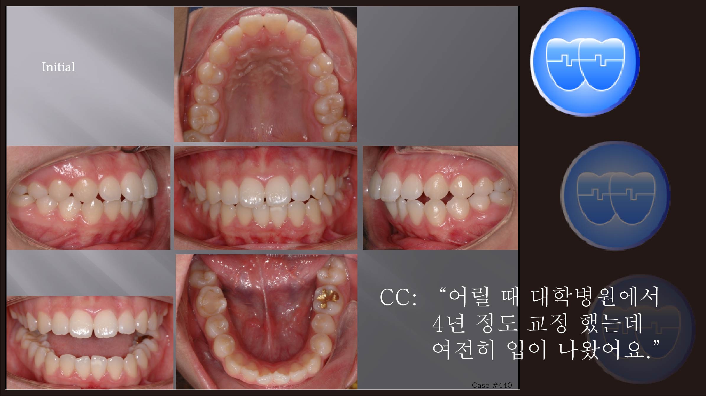 교정 Case 440.  재교정, Gummy Smile, Protrusion, Sem #7.5