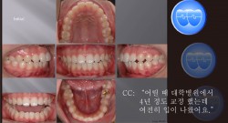 교정 Case 440.  재교정, Gummy Smile, Protrusion, Sem #7.5