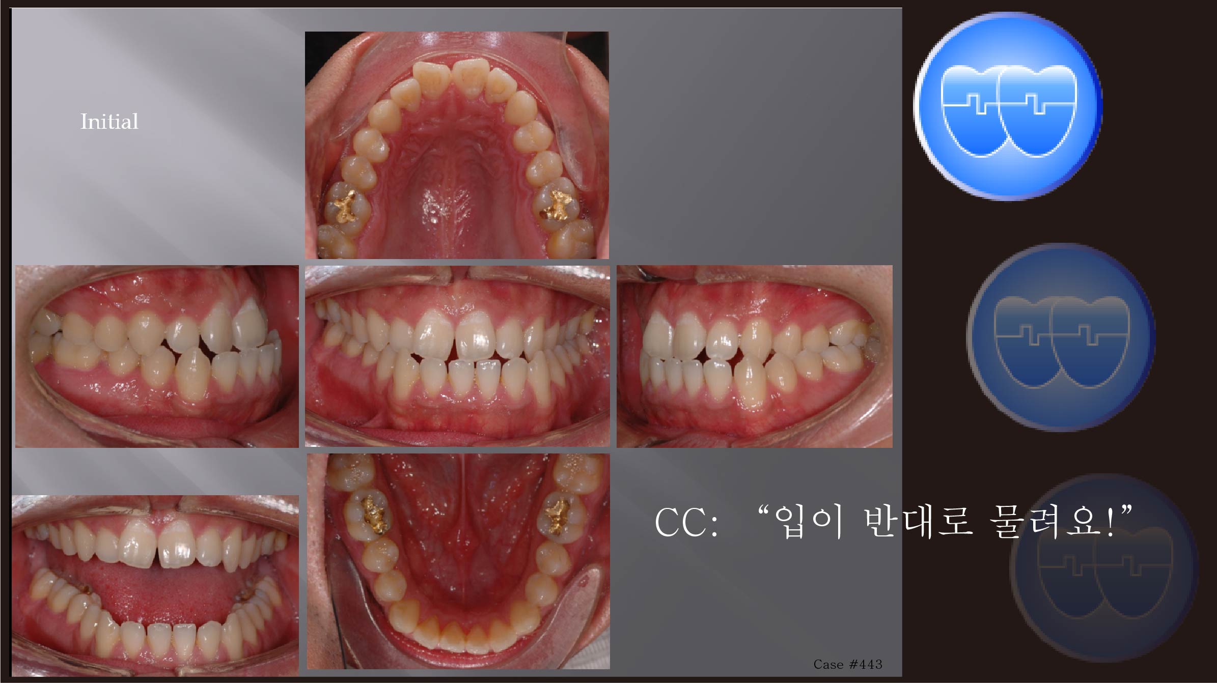 교정 Case 443.  Functional Shift, 비발치, Elastic으로 Mandible 돌리기, Sem #19