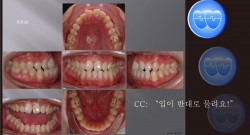 교정 Case 443.  Functional Shift, 비발치, Elastic으로 Mandible 돌리기, Sem #19