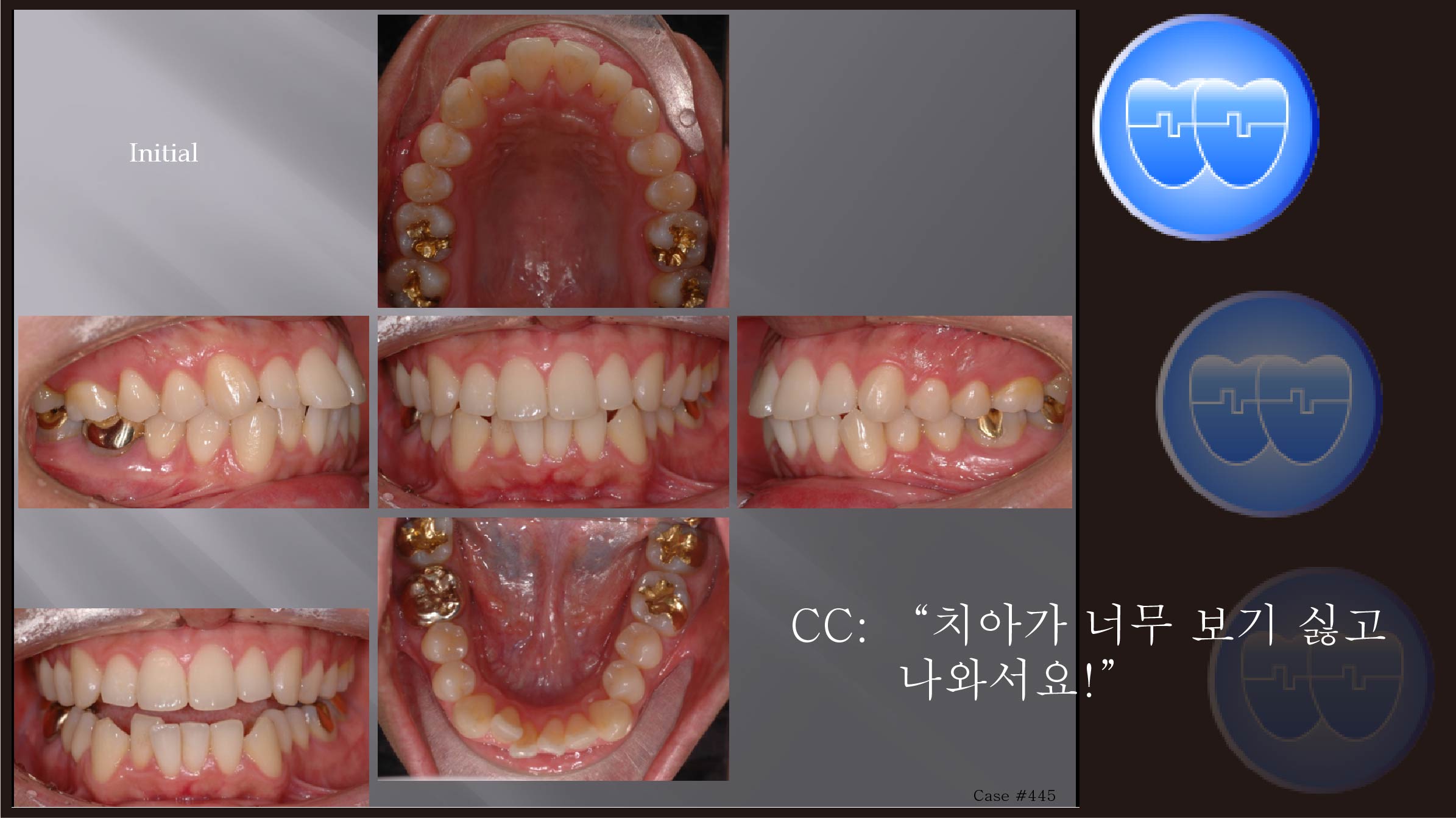 교정 Case 445.  U4L4 발치, Protrusion, Skeletal Class III, 성인, Sem #10