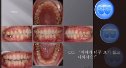 교정 Case 445.  U4L4 발치, Protrusion, Skeletal Class III, 성인, Sem #10