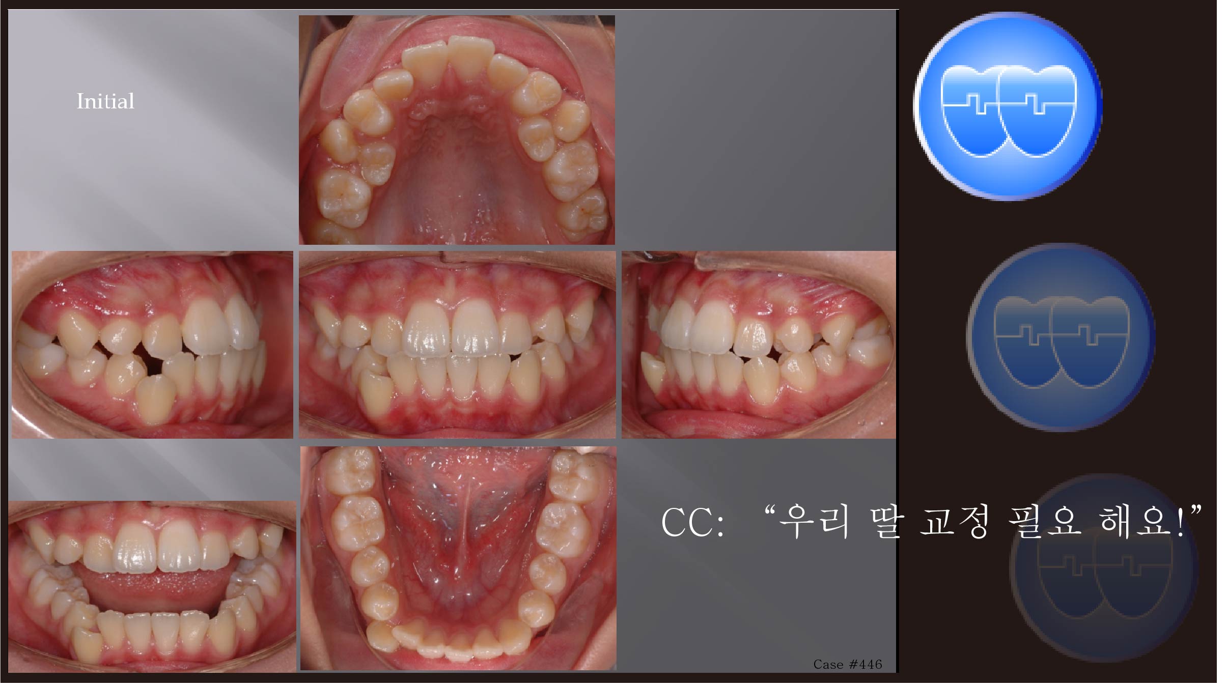 교정 Case 446.  Ectopic Eruption, Unusual Extraction, Lower Canine 발치, Sem #13.0