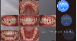 교정 Case 446.  Ectopic Eruption, Unusual Extraction, Lower Canine 발치, Sem #13.0