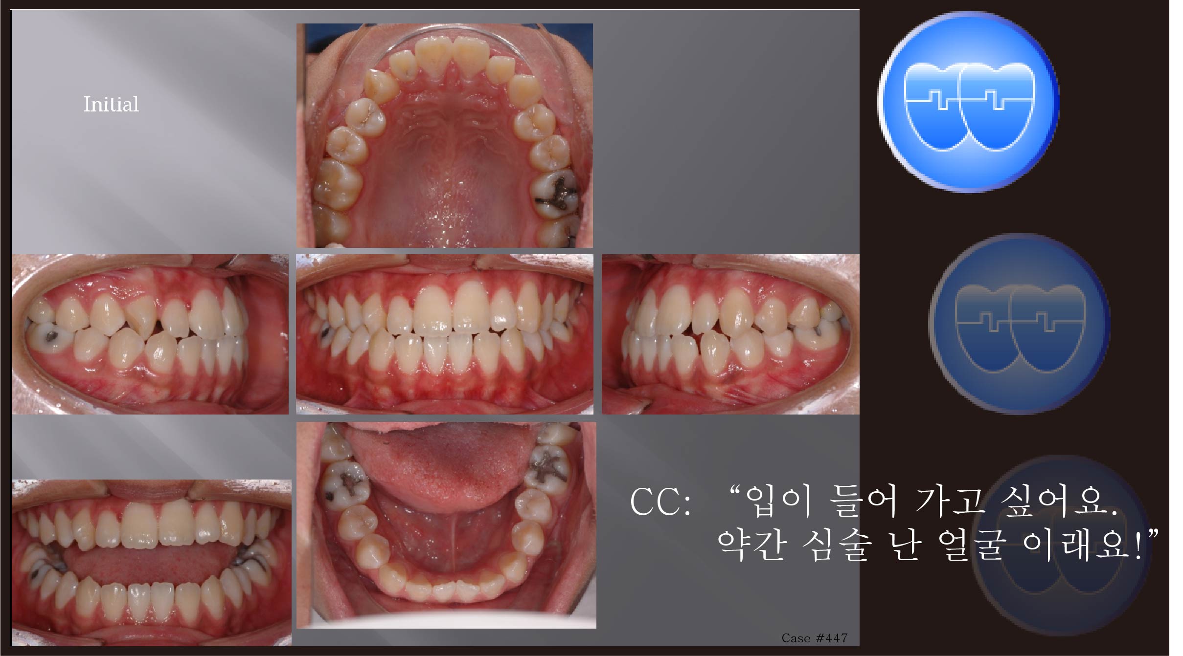 교정 Case 447.  U5L4 발치, 실수한 Case, Lower Incisor Torque Problem, Sem #12.3