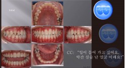 교정 Case 447.  U5L4 발치, 실수한 Case, Lower Incisor Torque Problem, Sem #12.3