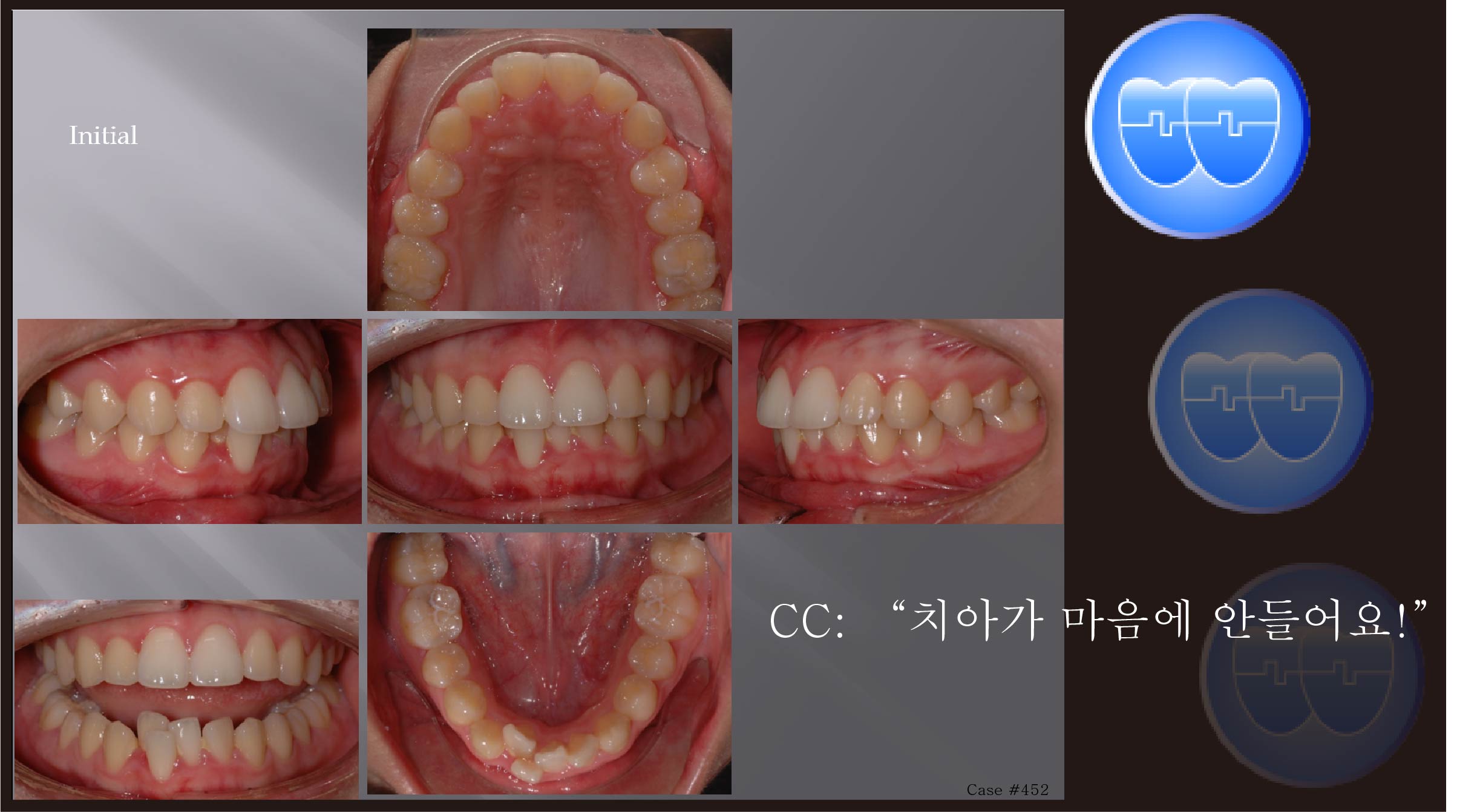 교정 Case 452.  U4L5 발치, Miniscrew 사용, Sem #5