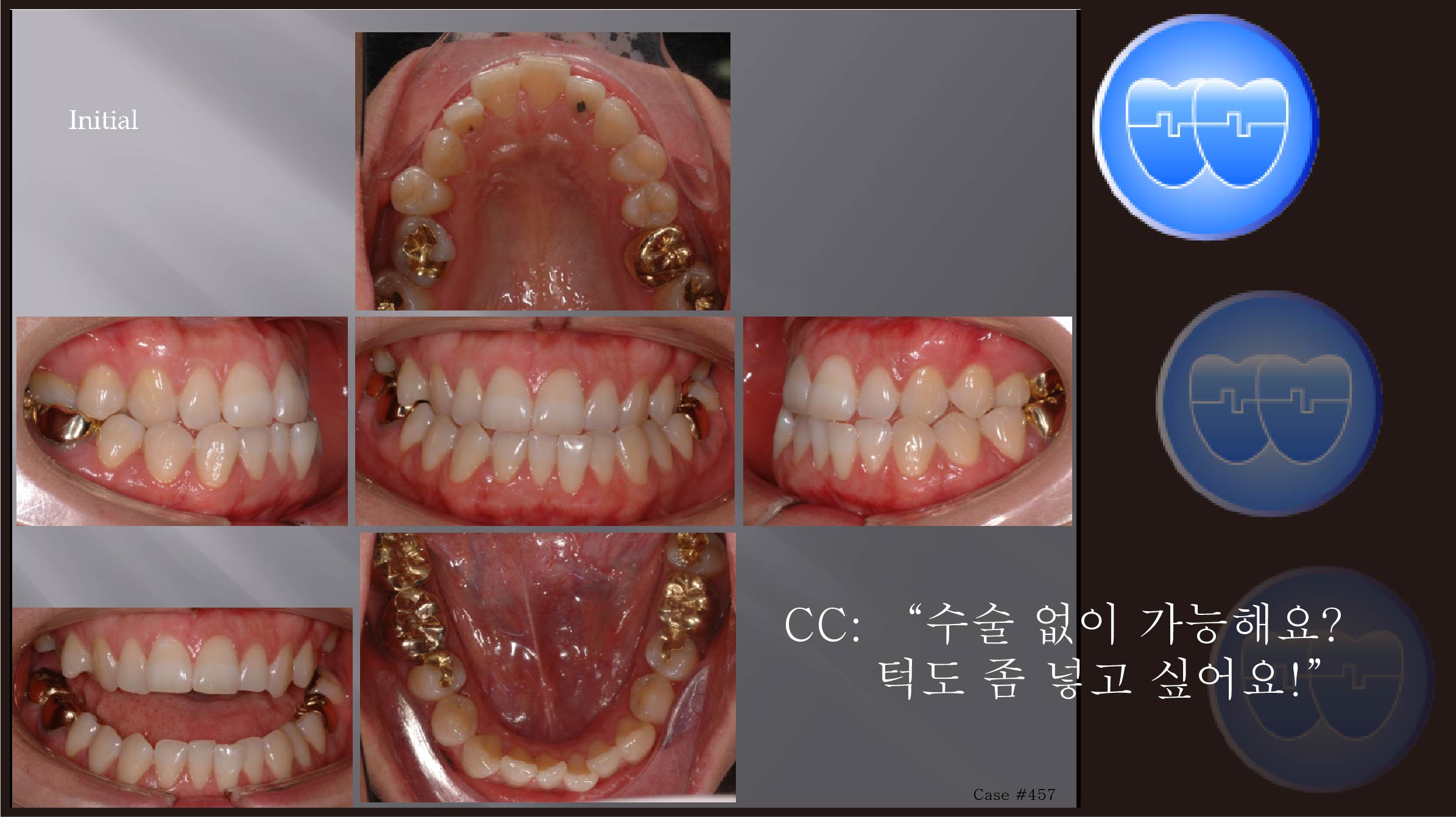 교정 Case 457.  Class III,  Lower lingual Corticotomy, Good Profile Change, Sem #13.7