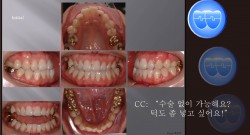 교정 Case 457.  Class III,  Lower lingual Corticotomy, Good Profile Change, Sem #13.7