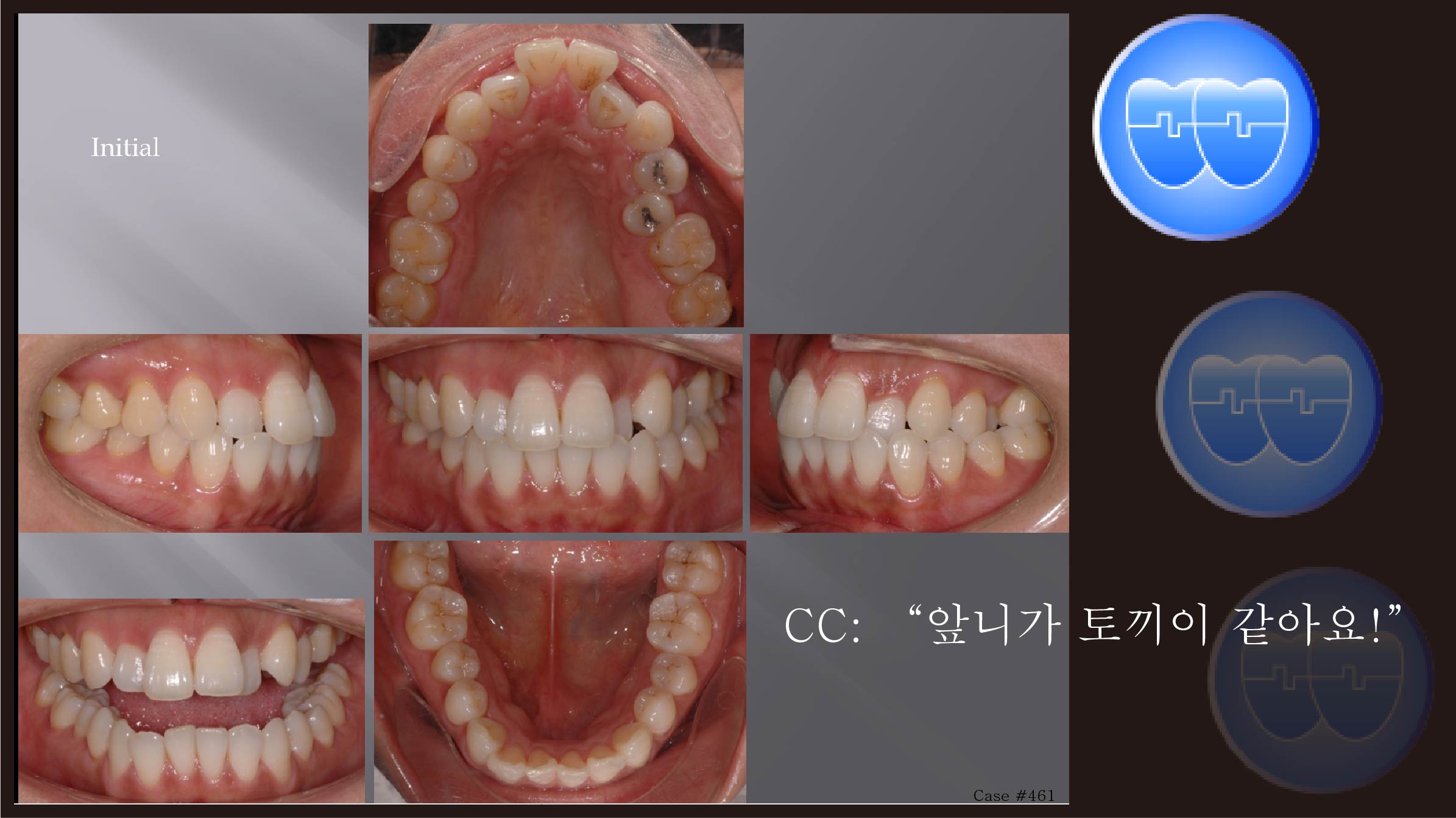 교정 Case 461.  U5L4 발치, Tori 영향,  Miniscrew 실패 후 재식립 성공, Sem #5.5