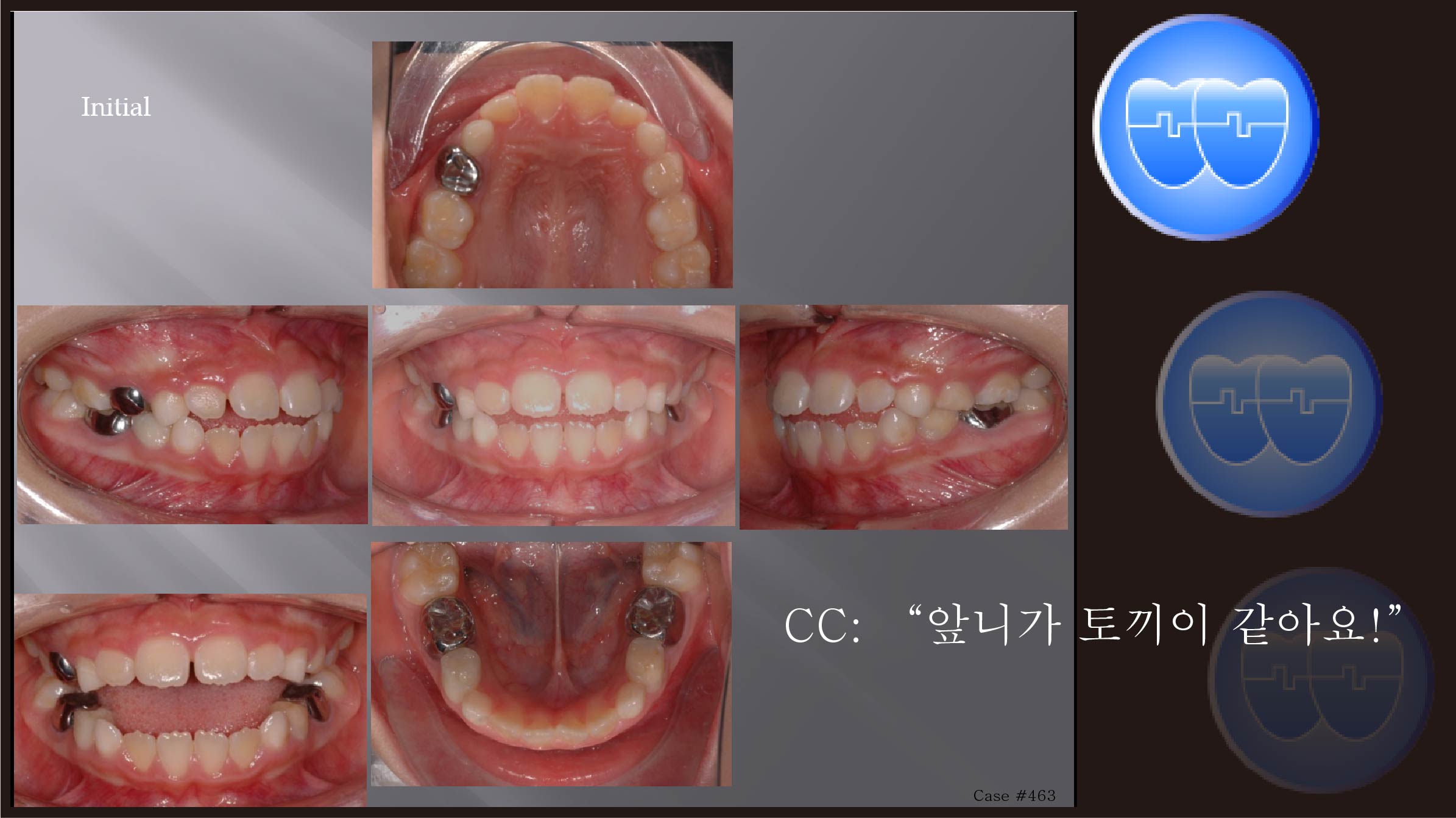 교정 Case 463.  1차 교정, Dental Openbite, Tongue Thrust, Lingual Cleats, Sem #9