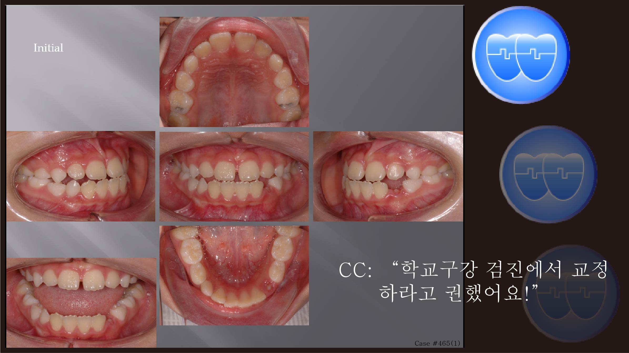 교정 Case 465(1).  비발치, RHG, Phase I, Sem #9