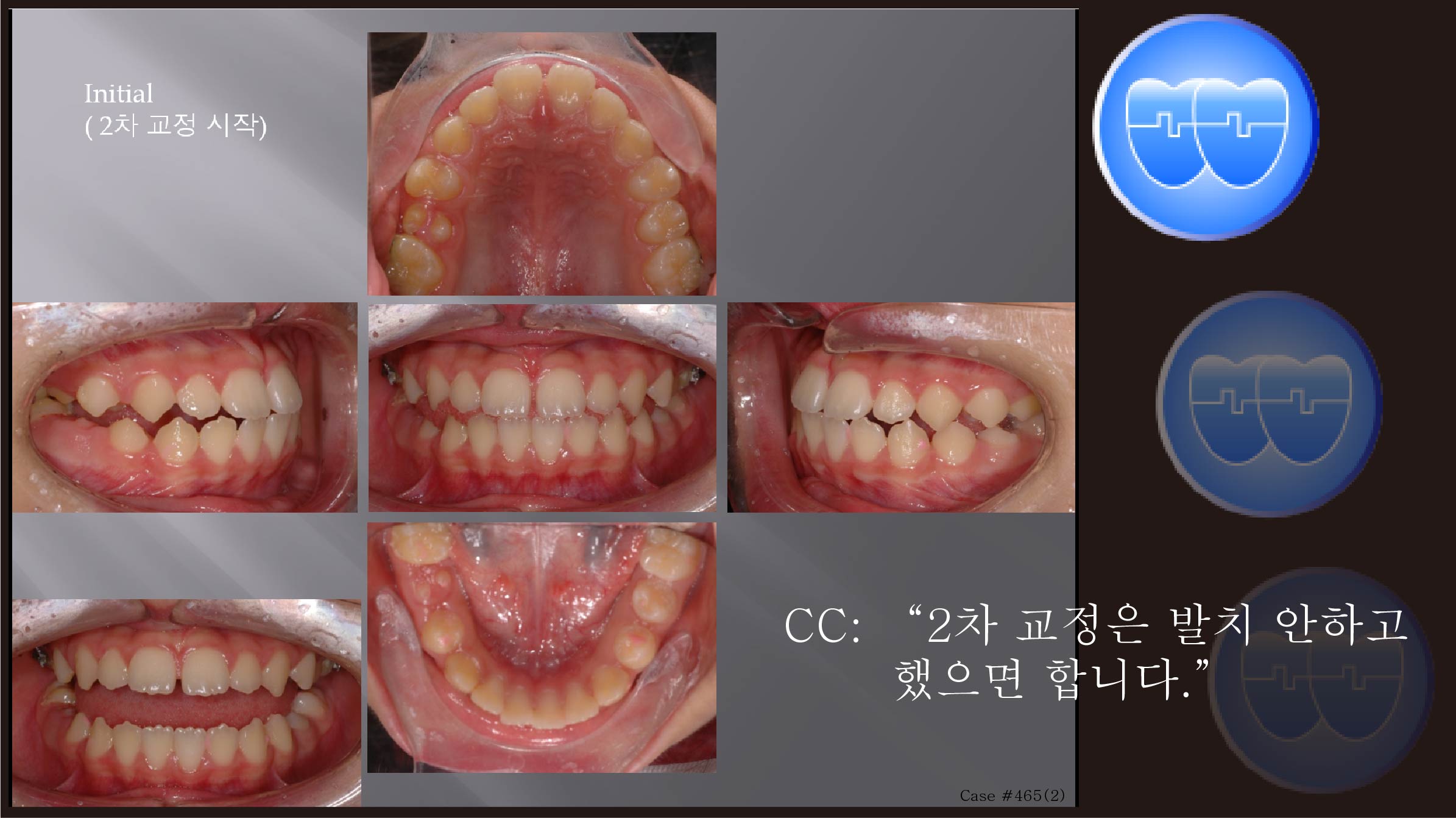 교정 Case 465(2).  비발치, RHG, Phase II, Relapse, Sem #18