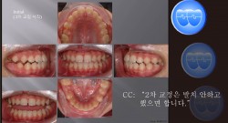 교정 Case 465(2).  비발치, RHG, Phase II, Relapse, Sem #18