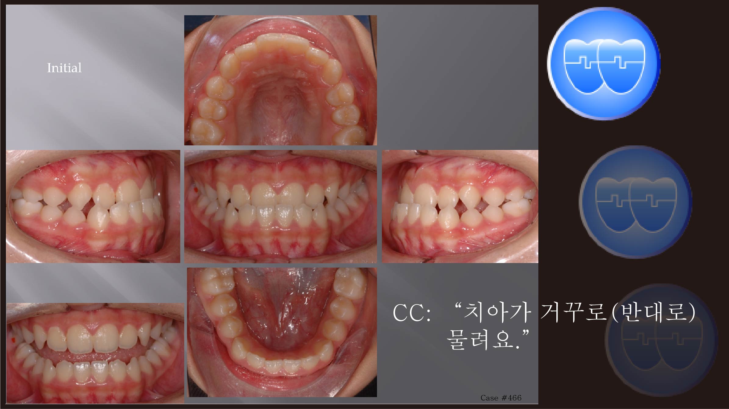 교정 Case 466.  비발치, Class III, Sem #16