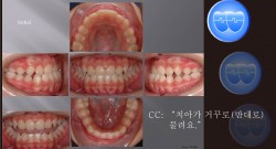 교정 Case 466.  비발치, Class III, Sem #16